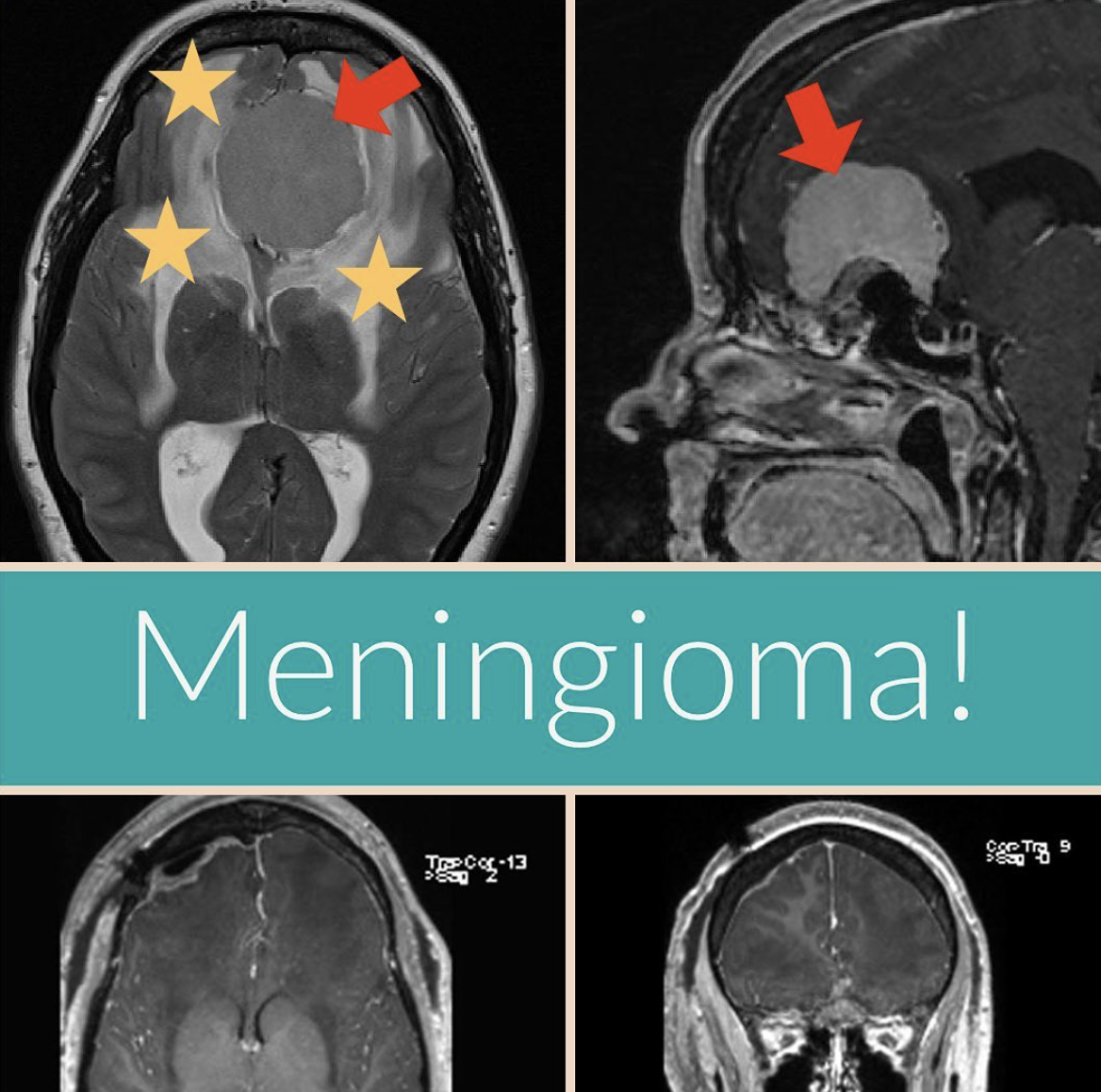 Meningioma — Matthew Mian, MD